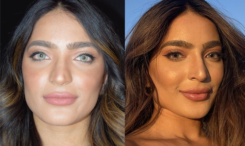non surgical facelift fillers before after mississauga oakville